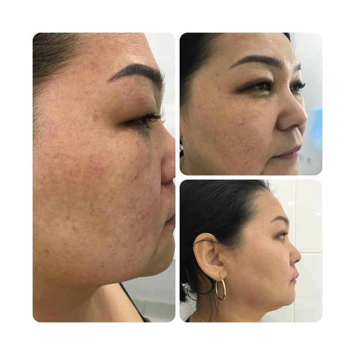 JeuDerm Zymo Complex 3*10 ml
