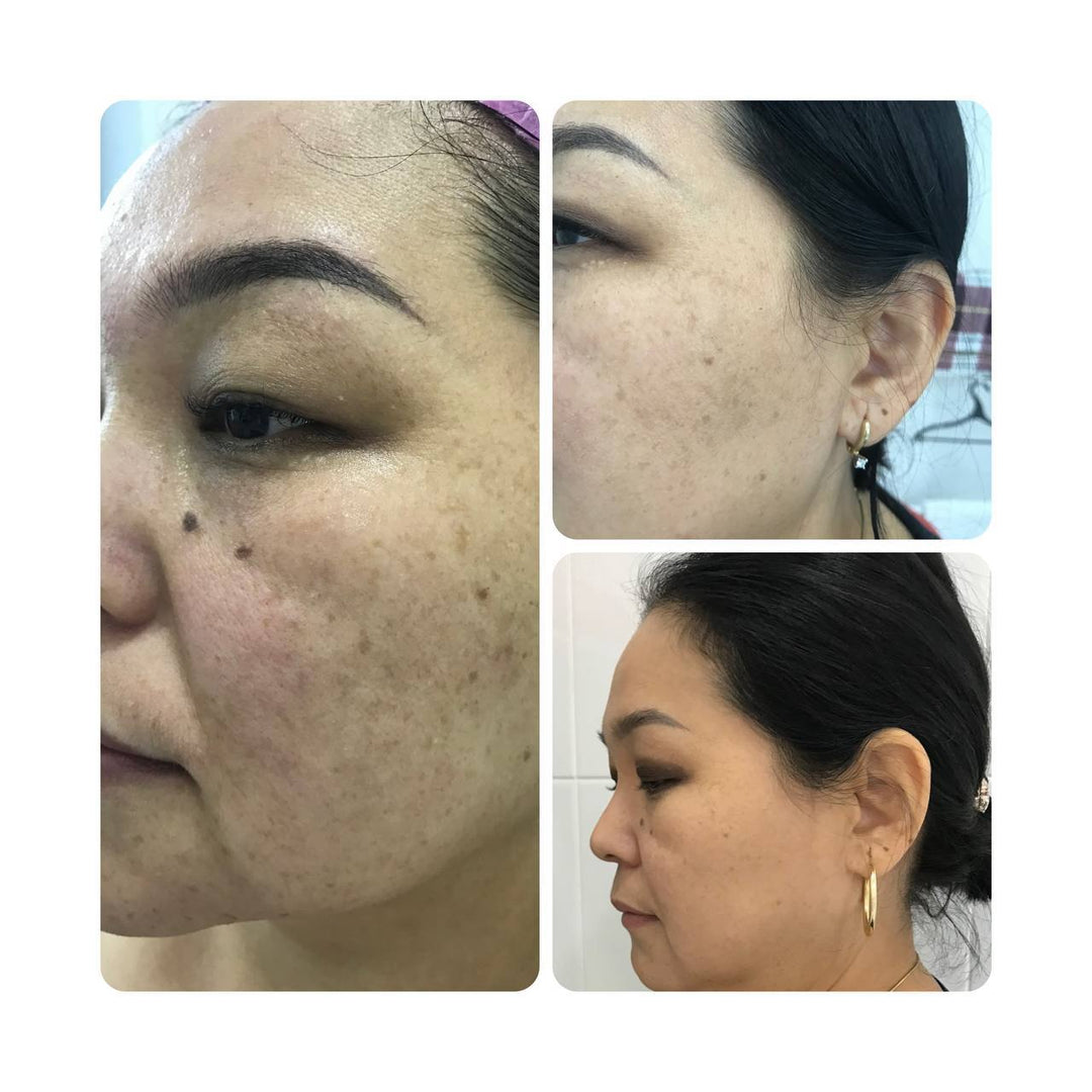 JeuDerm Zymo Complex 3*10 ml
