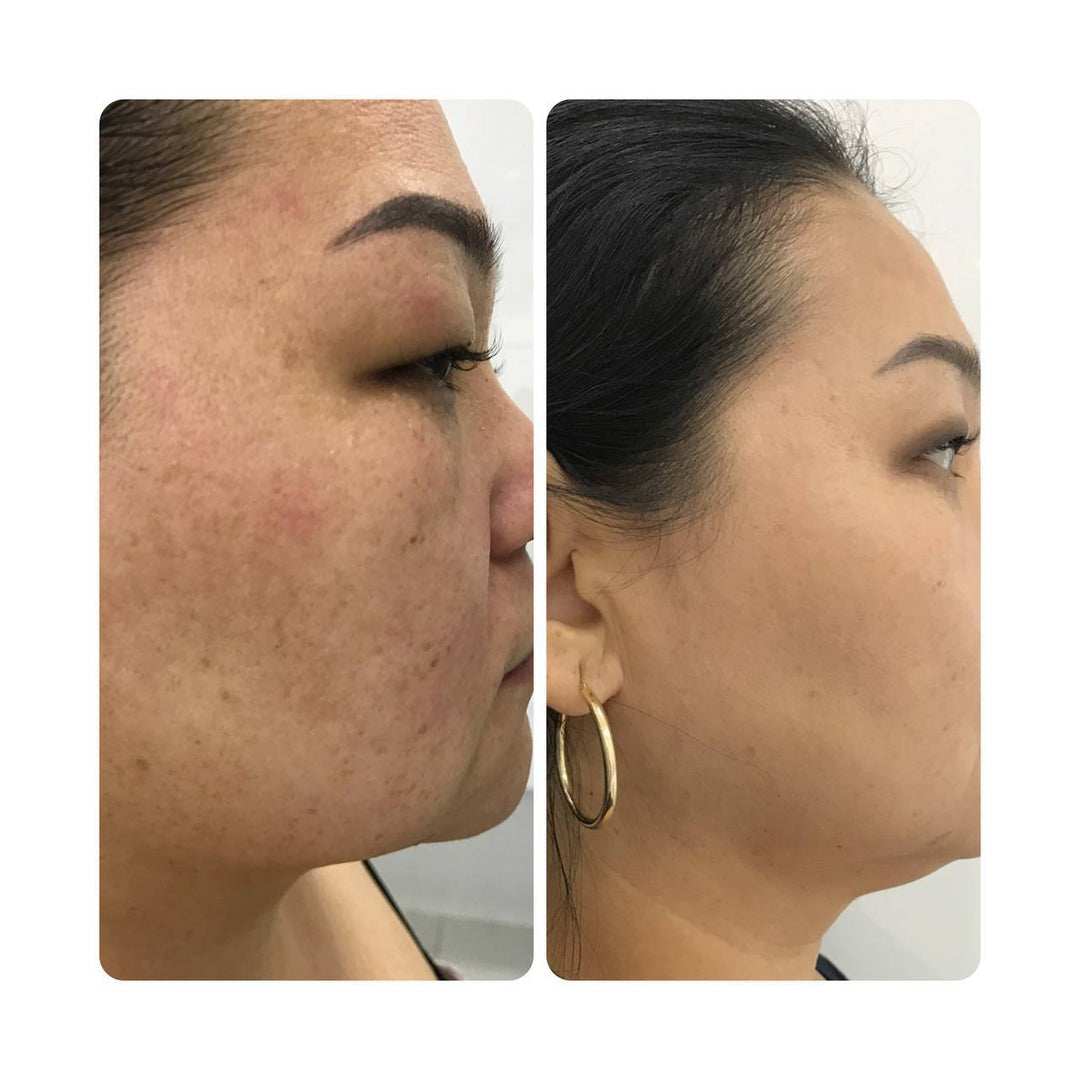 JeuDerm Zymo Complex 3*10 ml